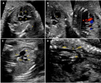 Case report: “Major fetal cardiac pathology associated with a novel CTNND1 mutation”